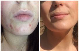 Dietary Tweaks For Improving Acne