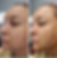 Dermaplaning