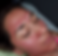 Microneedling