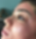 Microneedling