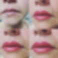 Correction of 10 year old lip color