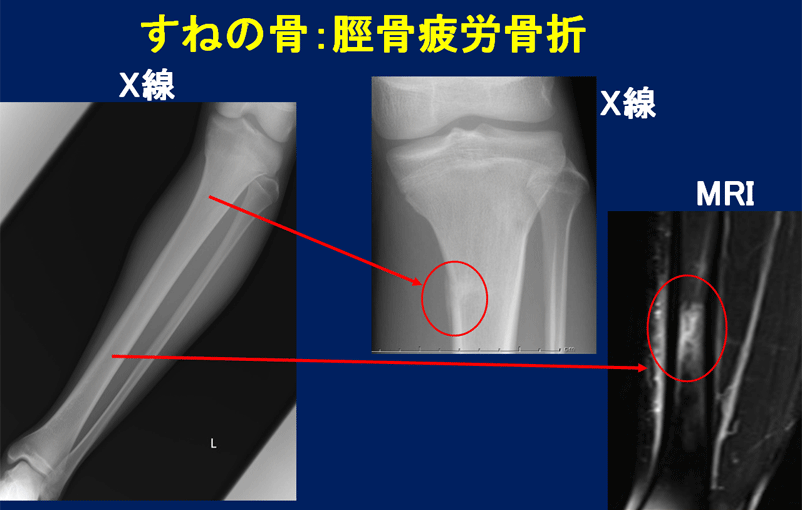 超音波骨折治療② 超音波骨折治療②