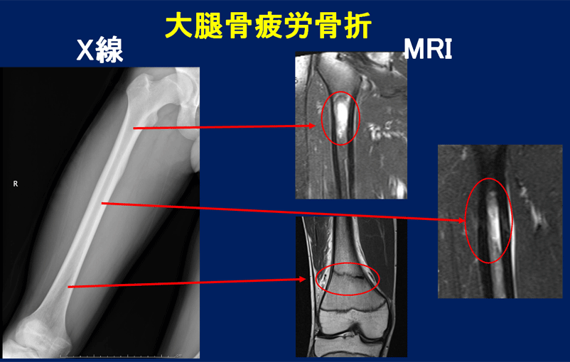 超音波骨折治療②