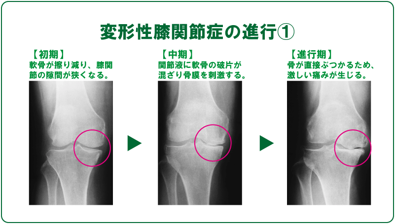 寒くなると膝が痛む