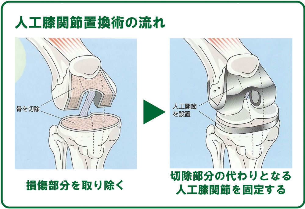 人工膝関節置換術[TKA]のすべて S115803486 - 健康・医学快適