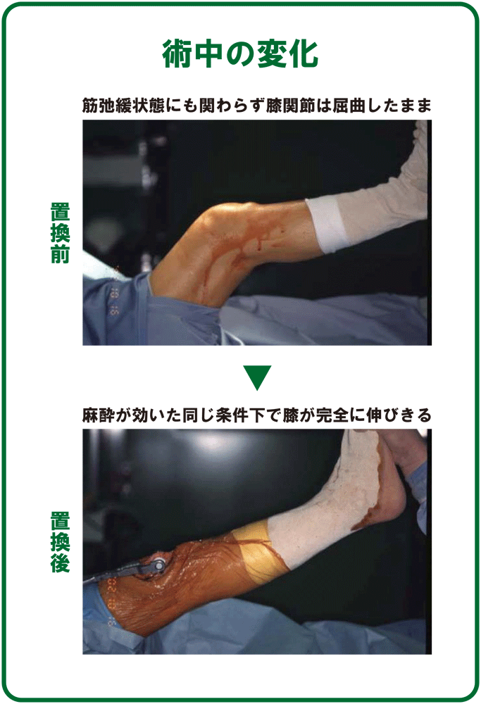 人工膝関節置換術 我汝会きたひろしま整形外科