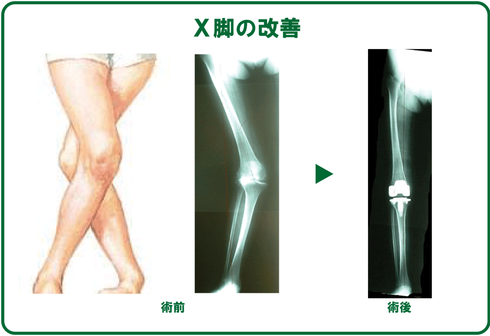 人工膝関節置換術 我汝会きたひろしま整形外科