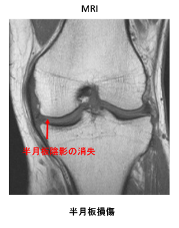 変形性膝関節症 ランナーへ