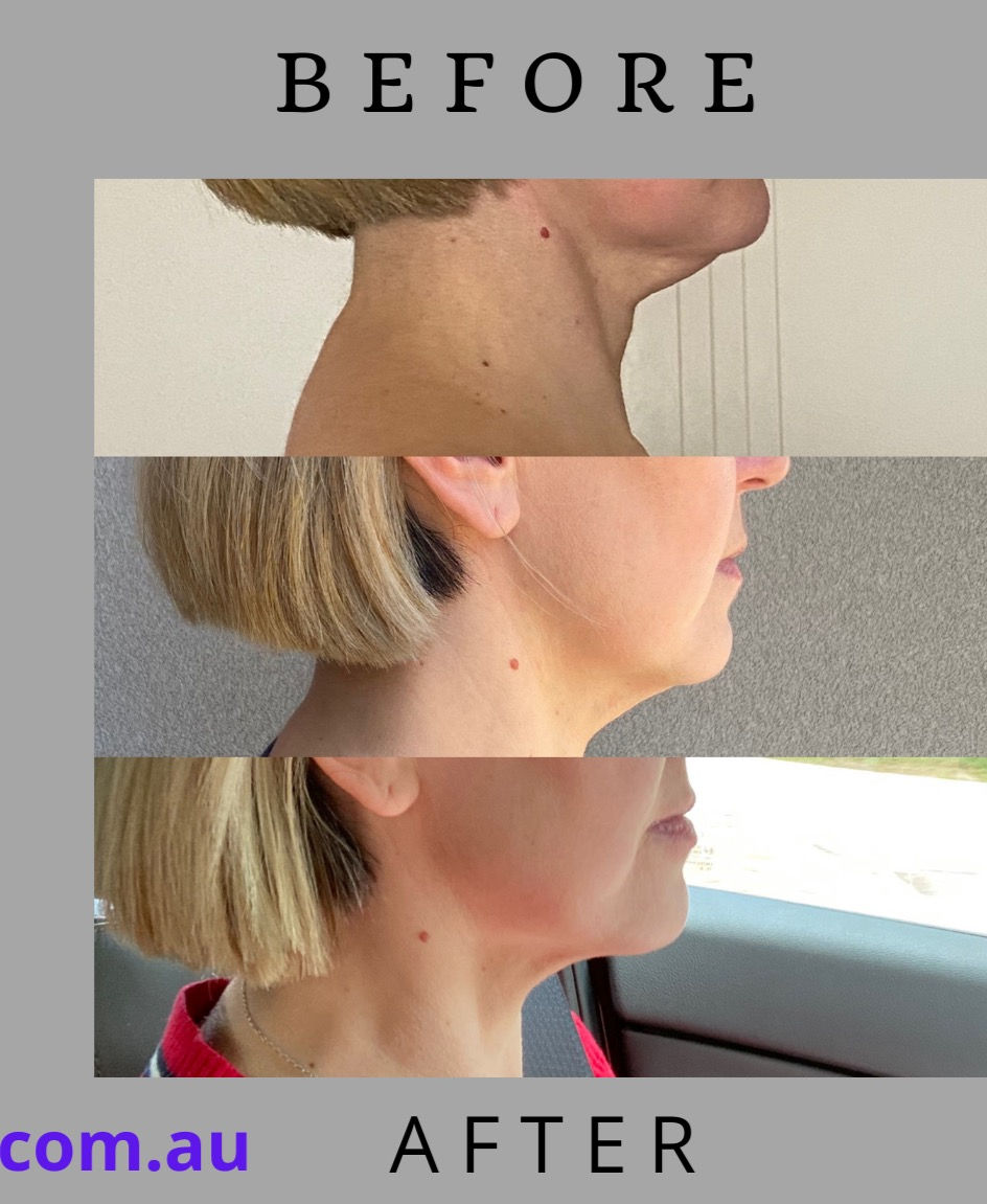 remove double chin, yoga for face_edited