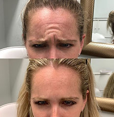 Renova Botox Before & After - 5