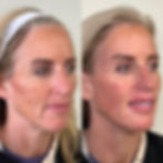 Full Facial balancing with fillers