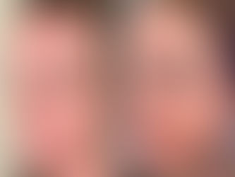 BBL|Moxi: Laser Skin Rejuvenation at Renova Medical Aesthetics in Castle Rock, CO