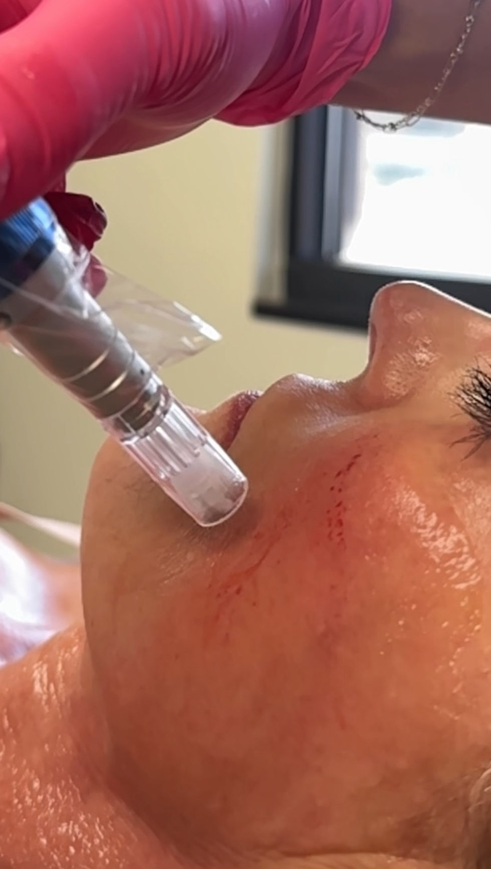 microneedling