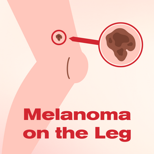 MELANOMA ON THE LEG: UNDERSTANDING DETECTION AND PROGNOSIS