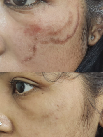 Before/After Image for Fungal Infection Treatment