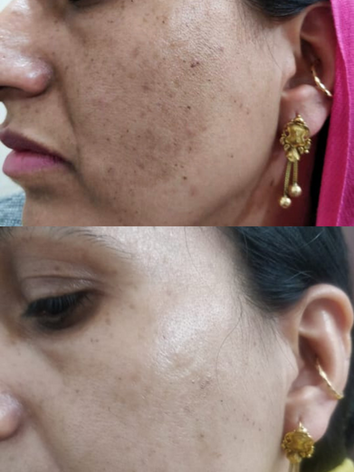 Before/After Image for Pigmentation Treatment