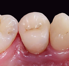 בלוק היברידי לשיניים