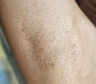 Epilation laser avant.jpeg