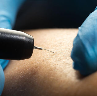 Epilation par électrolyse