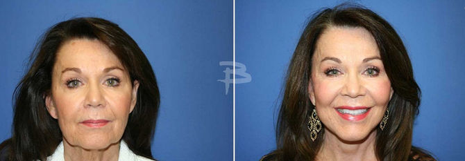 Facelifts Remain a Popular Cosmetic Surgery in San Diego