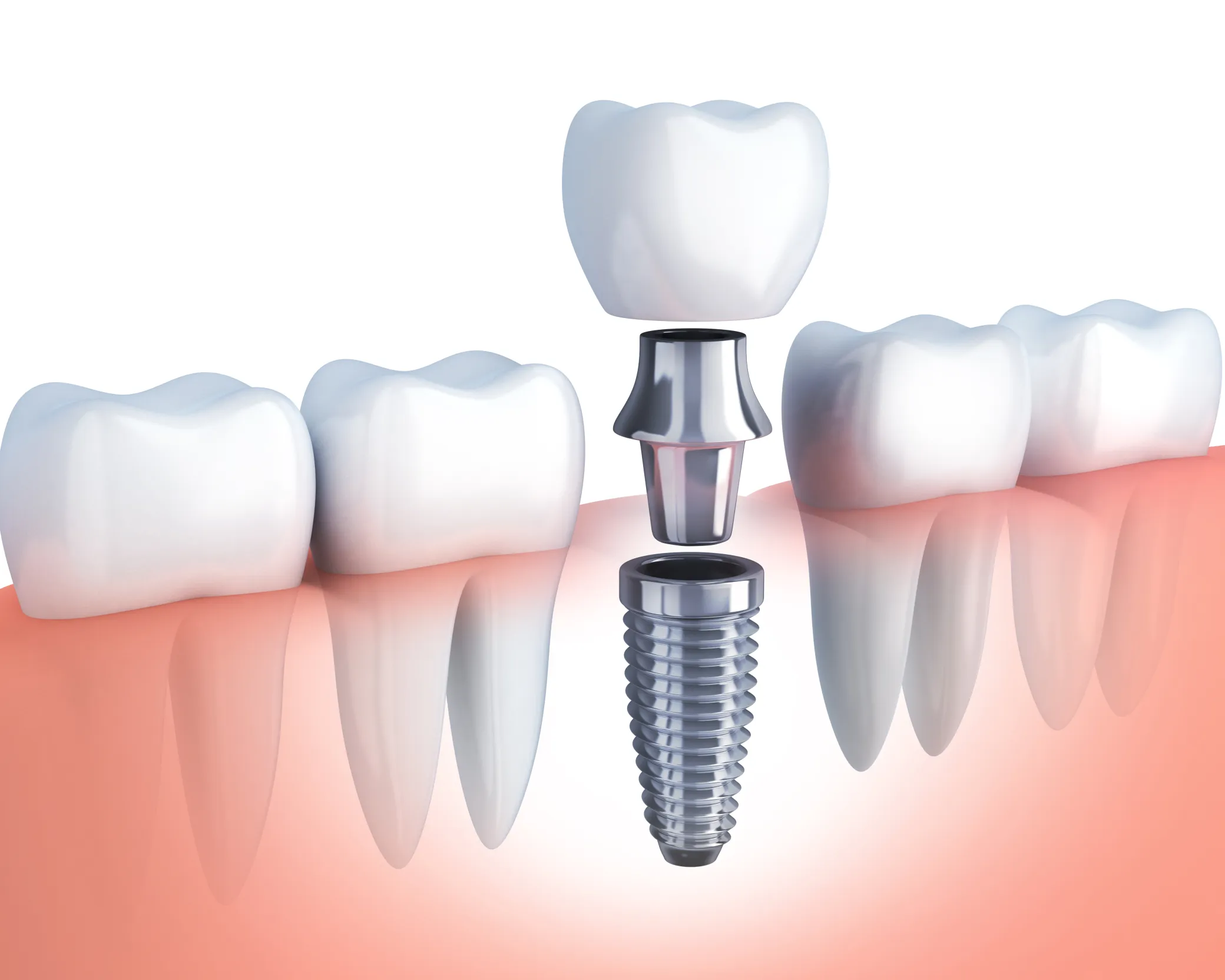 iStock-648420784-Dental-Implant.jpg.webp
