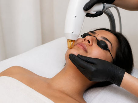 Treat PCOS Hirsutism With Laser Therapy: A Complete Guide