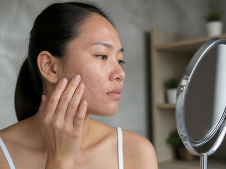 How to Prevent Dark Spots After Acne Breakouts