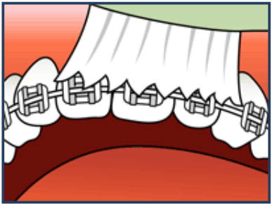 Brushing & Flossing Your Teeth with Braces
