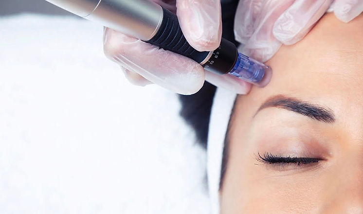MICRONEEDLING.jpeg