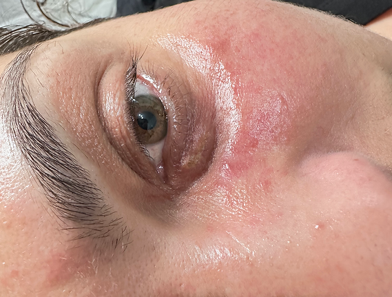 XANTHELASMA TREATMENT IN CLEETHORPES.HEIC