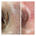Xanthelasma Removal. How Can You Get Rid of It for Good?