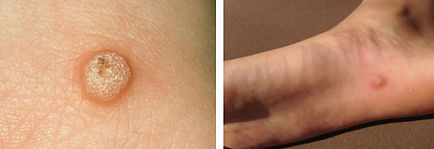 skin tags removal cleethorpes
