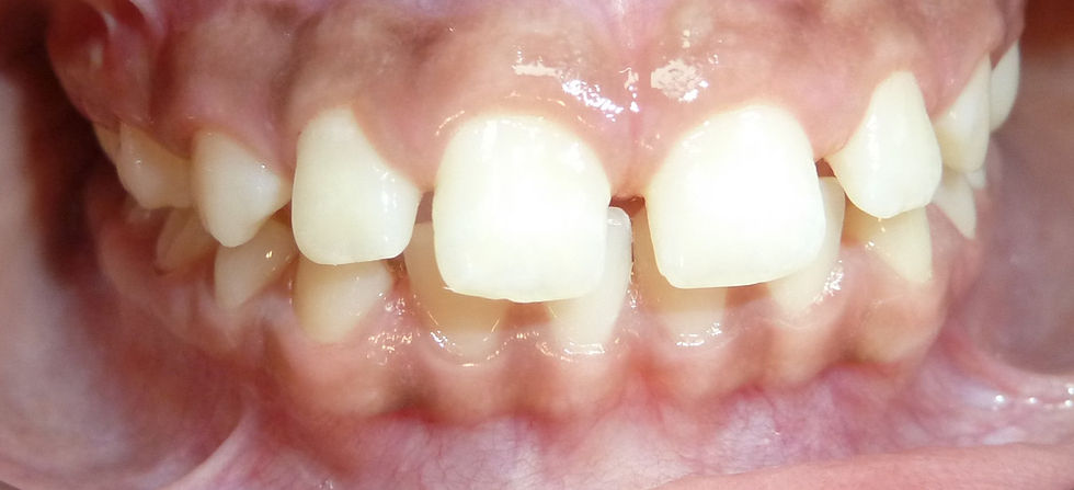 GN before braces.jpg