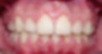 AO after braces.jpg