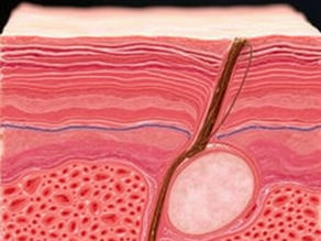 Cellulite Under Skin