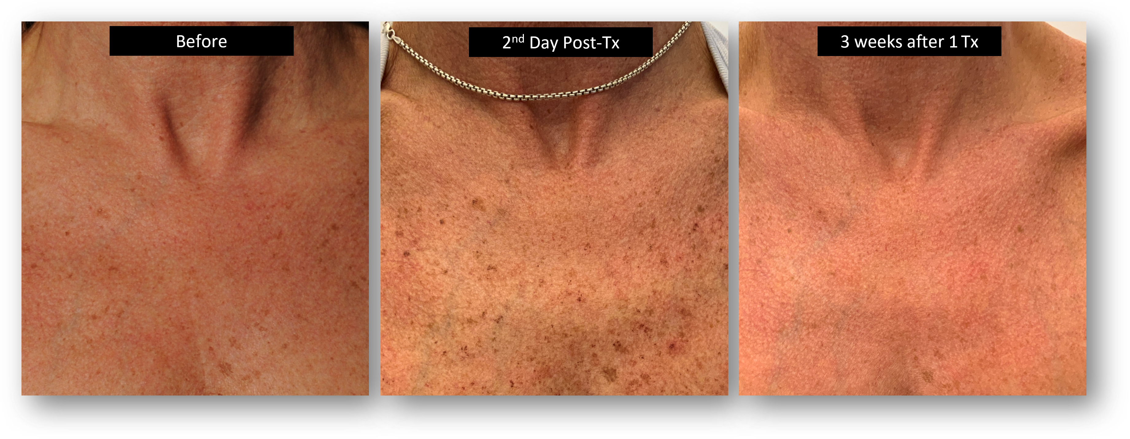 DermaV Laser before and after result 1