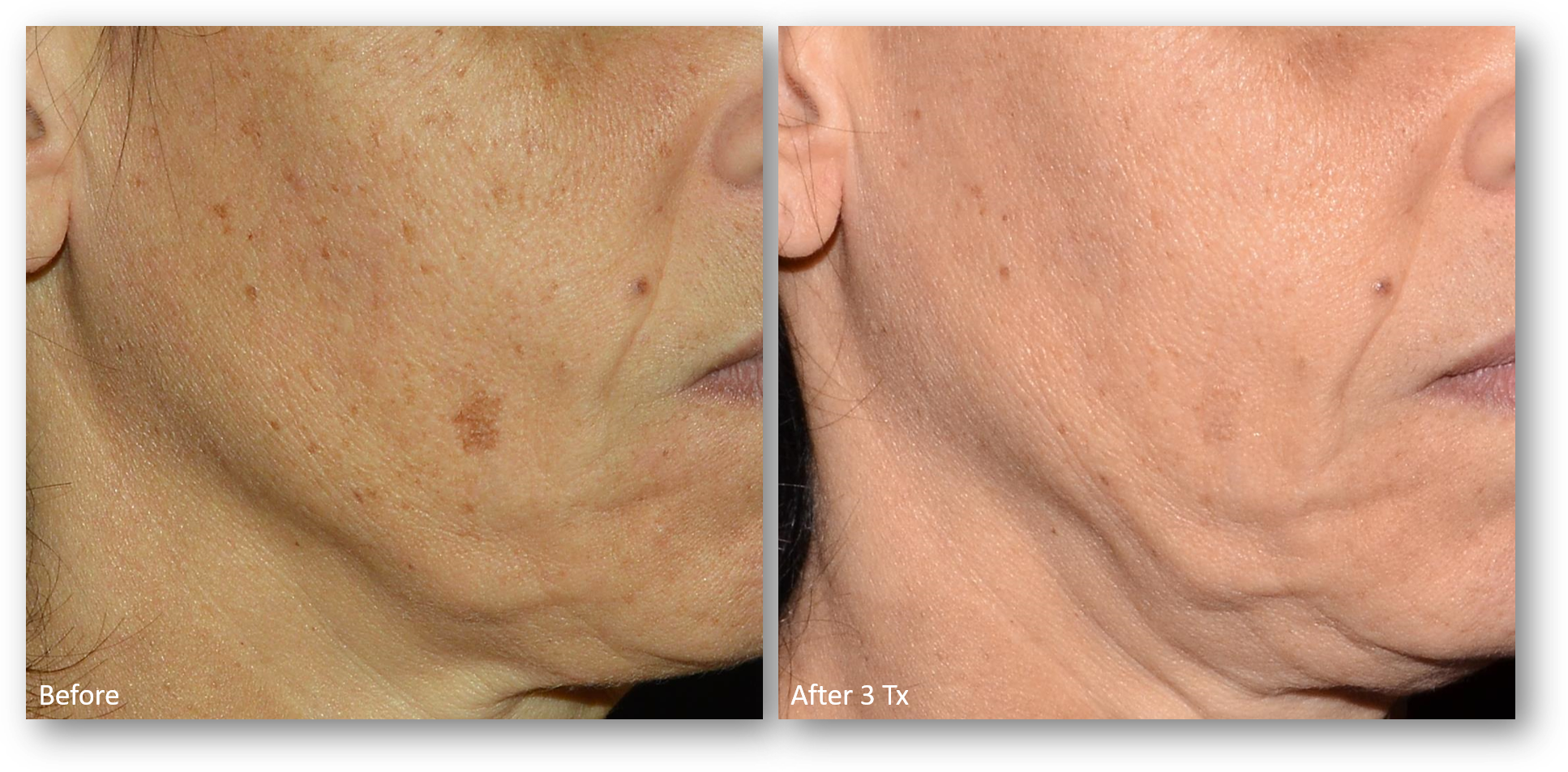 LaseMD Ultra before and after result 2