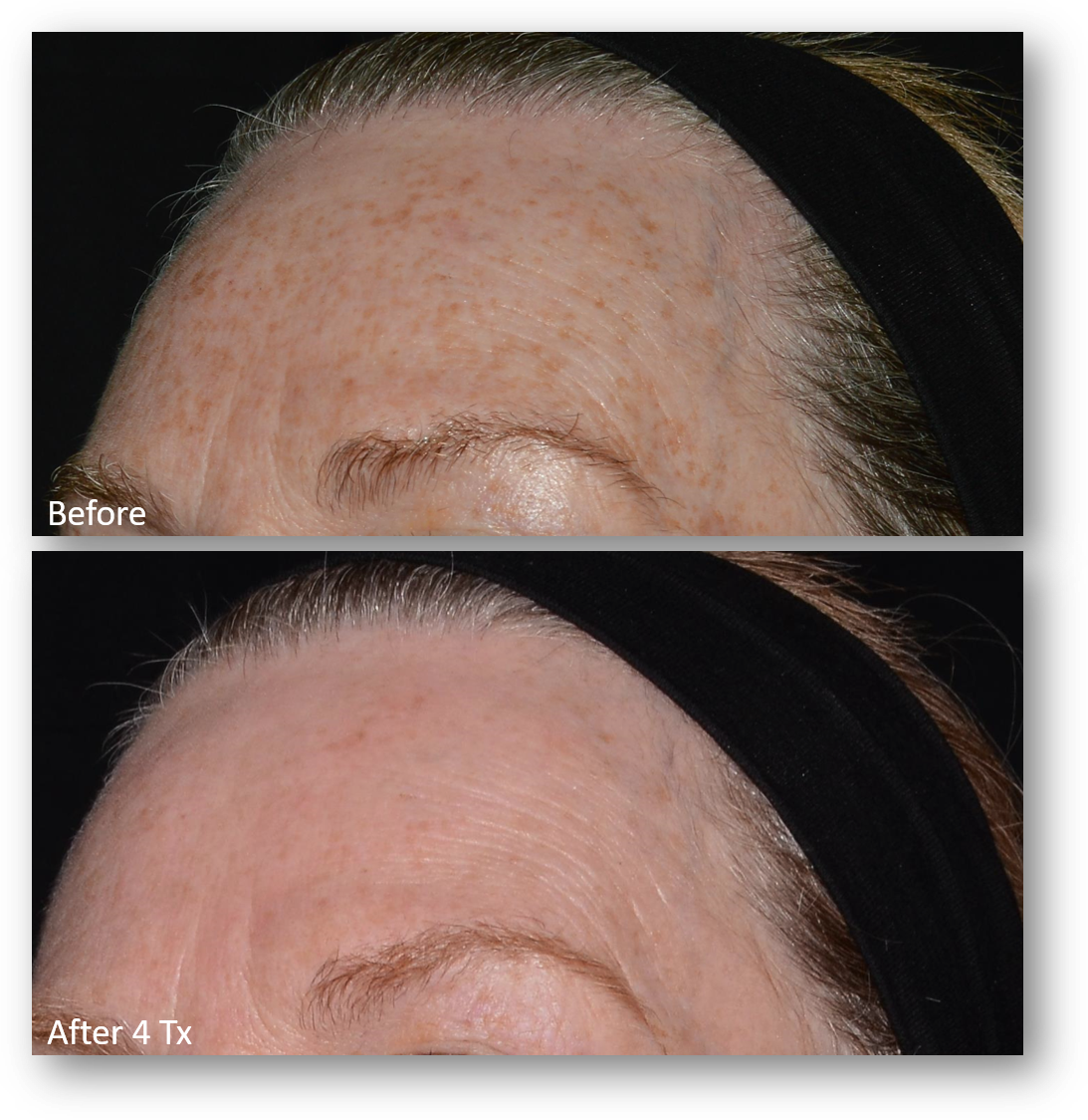 LaseMD Ultra before and after result 12