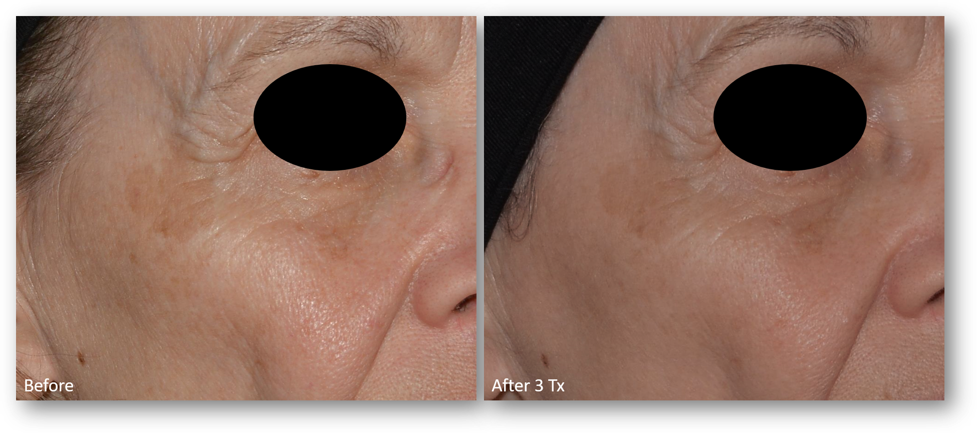 LaseMD Ultra before and after result 13