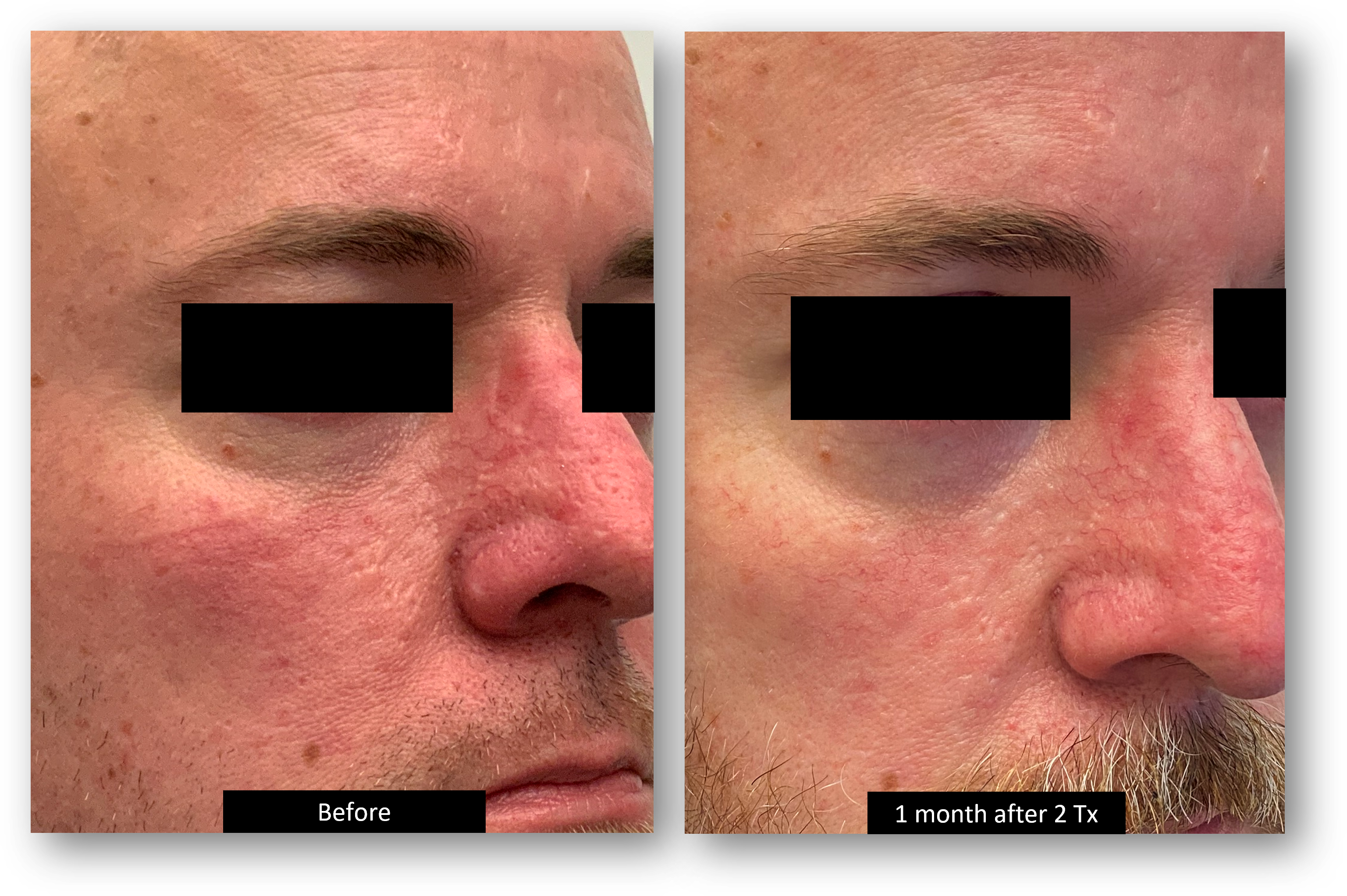 DermaV Laser before and after result 7