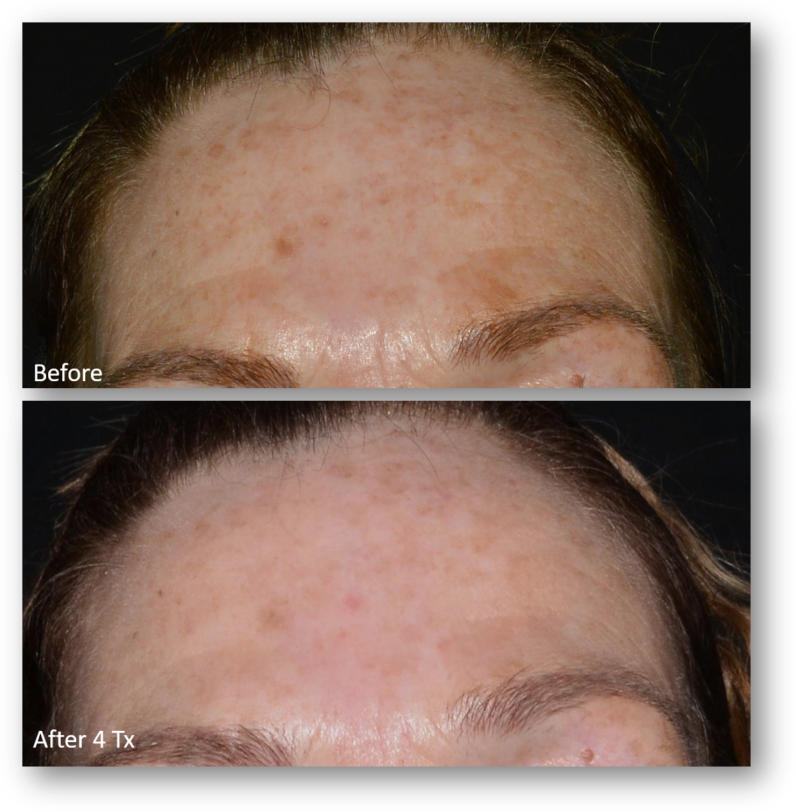 LaseMD Ultra before and after result 16