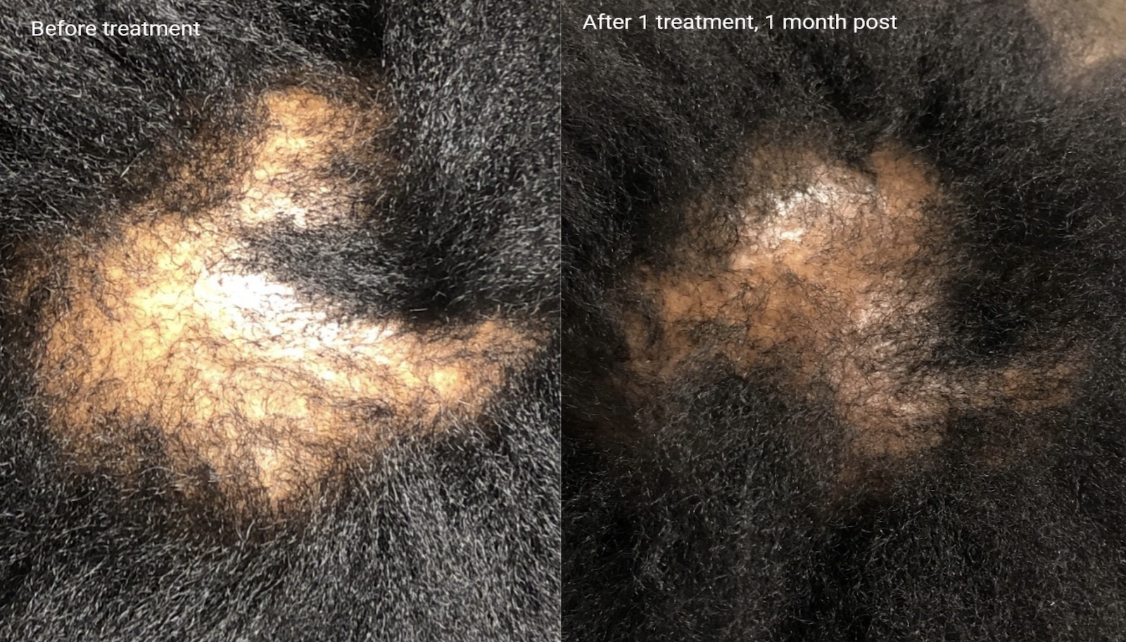 Hair loss treatment before and after - patient 3