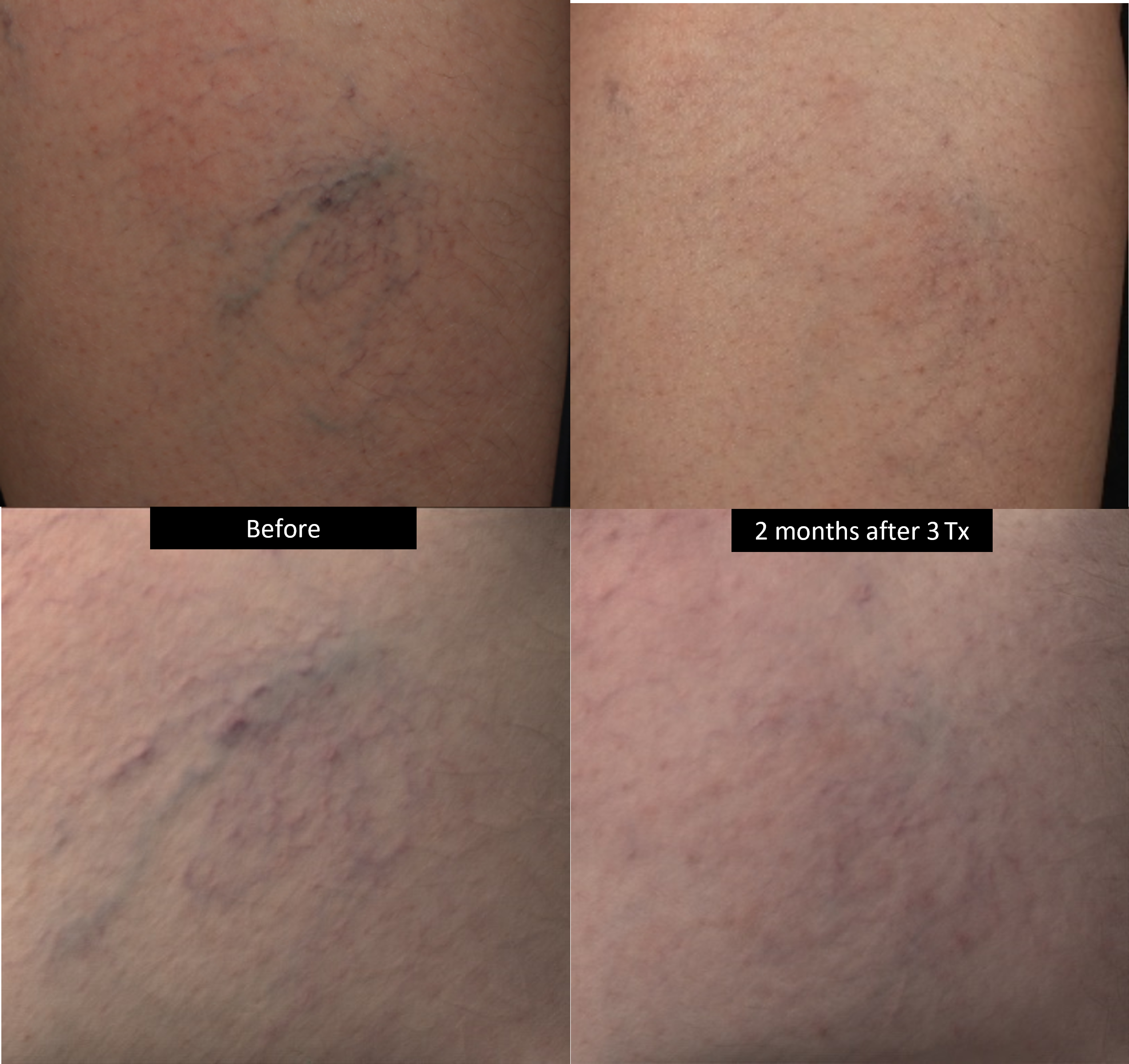 DermaV Laser before and after result 6