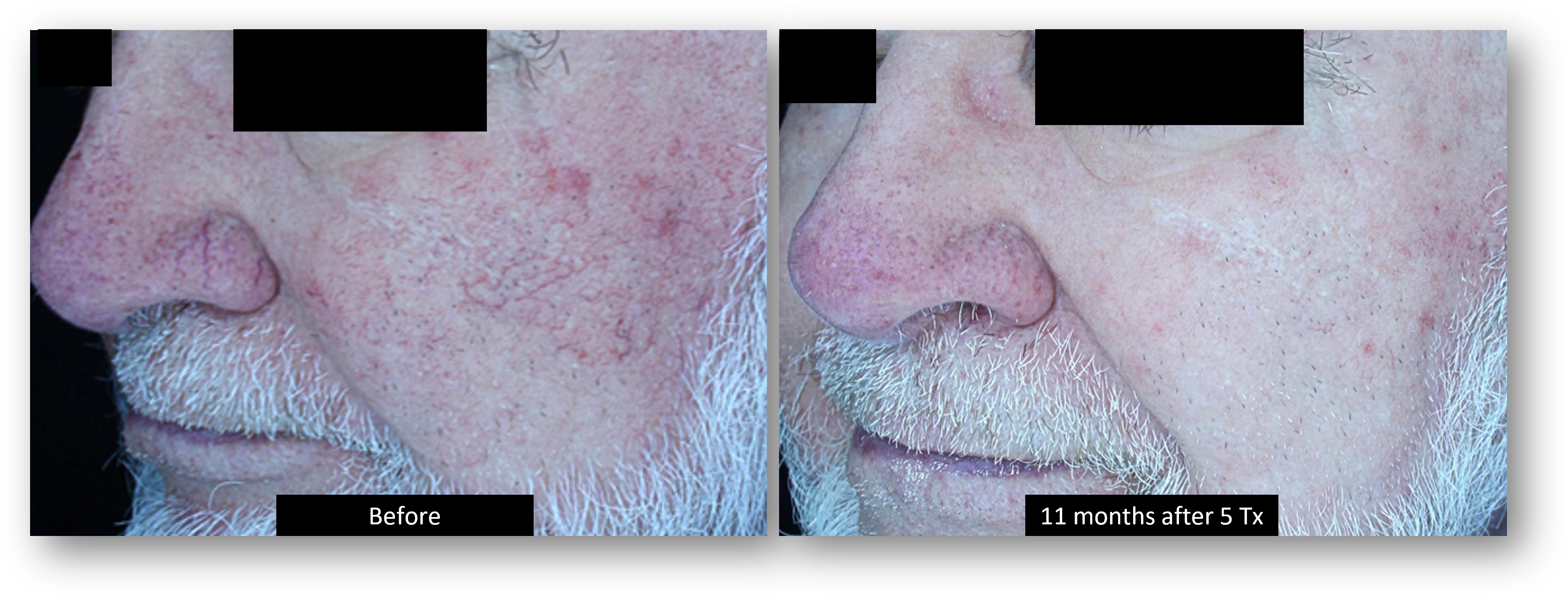 DermaV Laser before and after result 8