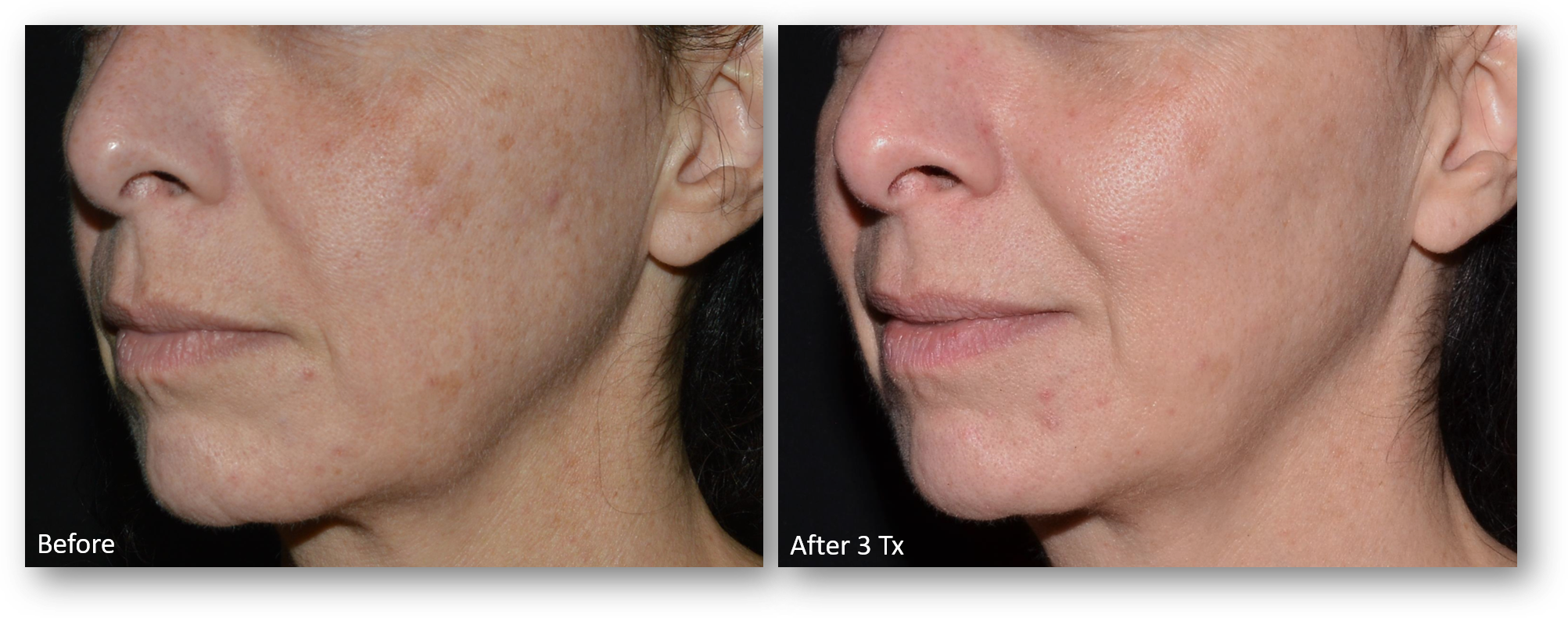 LaseMD Ultra before and after result 7