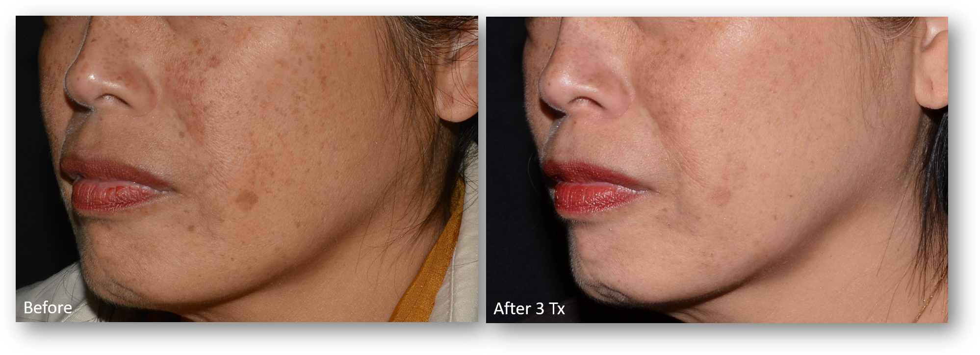 LaseMD Ultra before and after result 6
