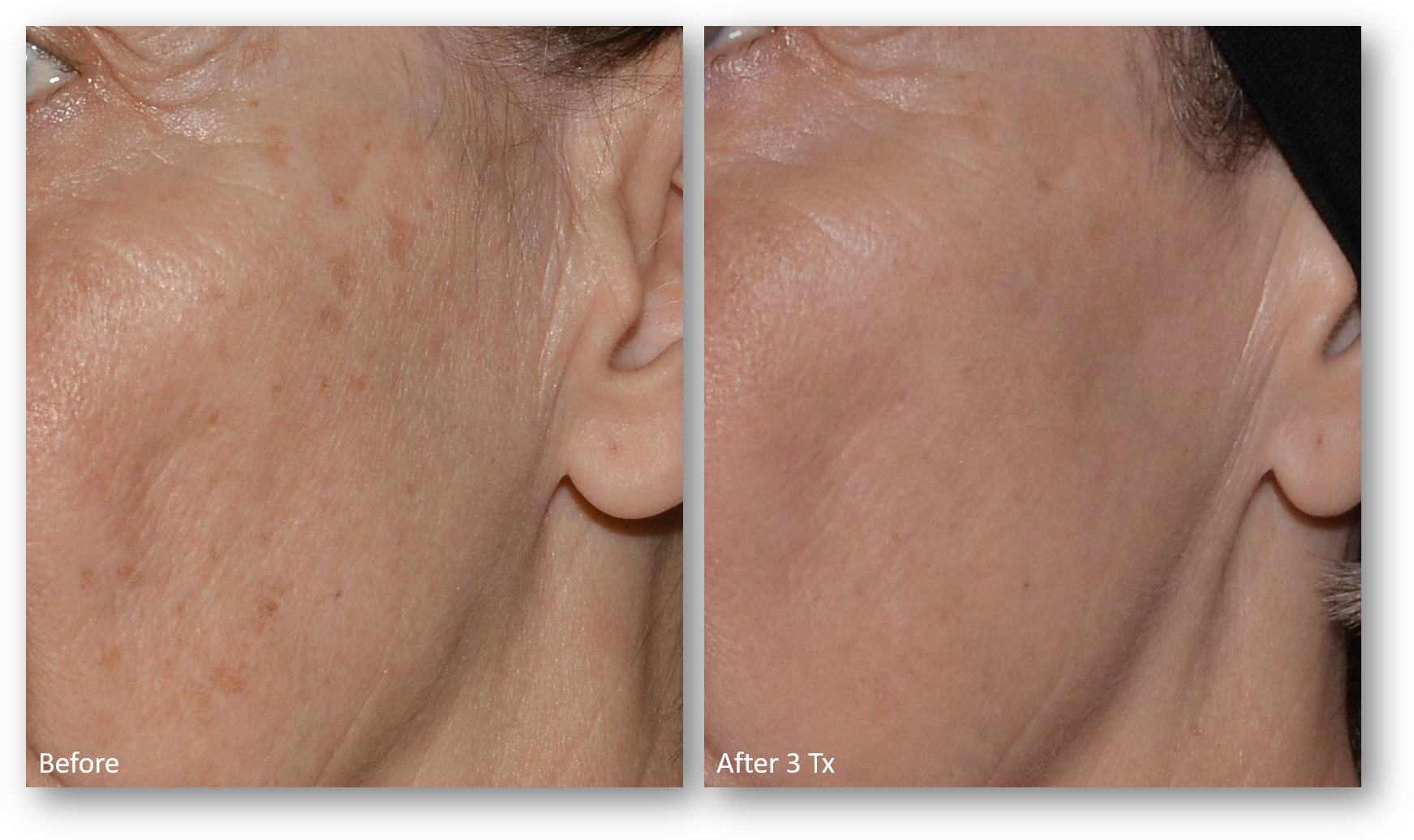 LaseMD Ultra before and after result 11