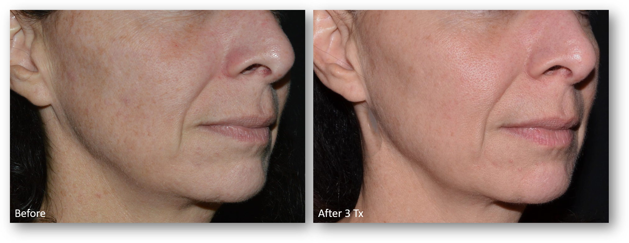 LaseMD Ultra before and after result 9