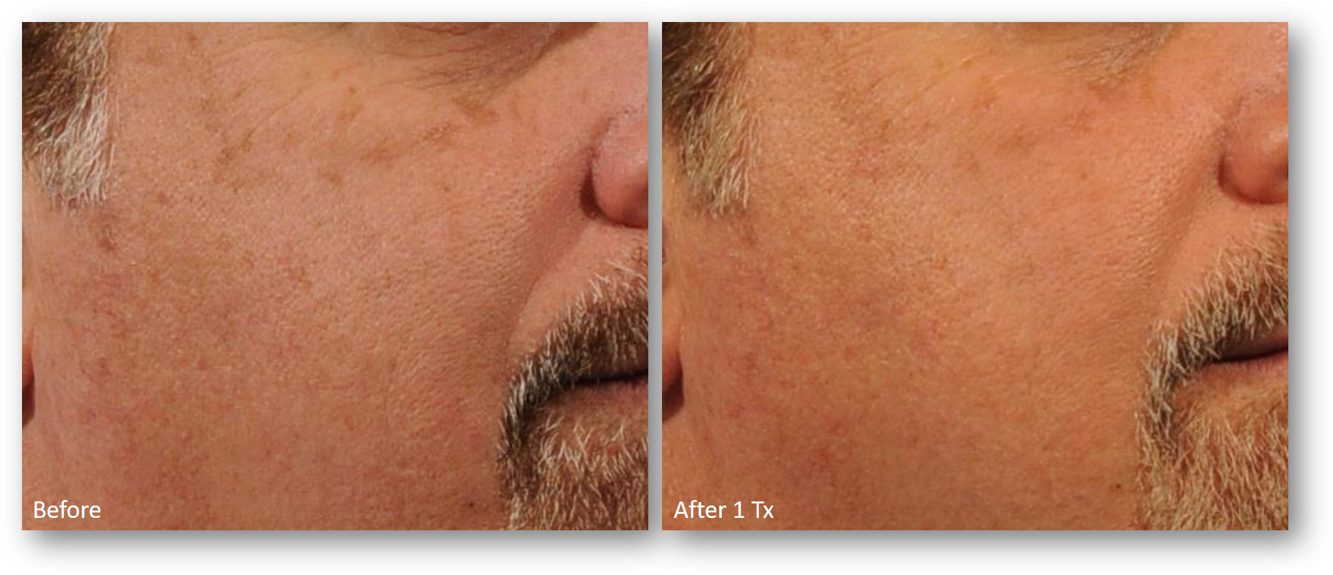 LaseMD Ultra before and after result 4