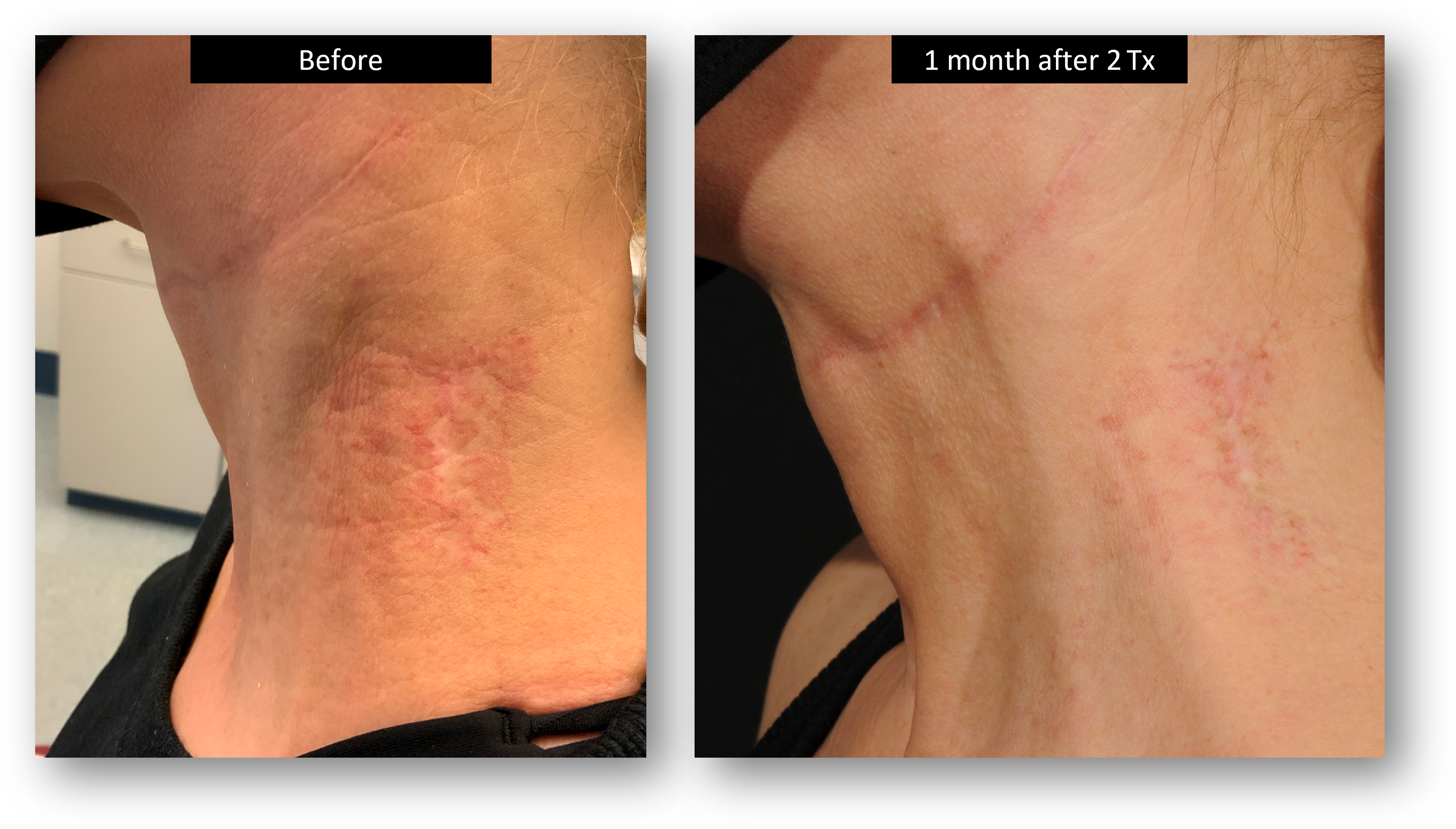 DermaV Laser before and after result 3